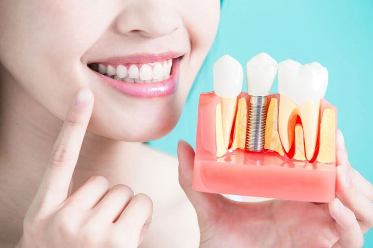 How to keep your dental health optimal after Dental Implants