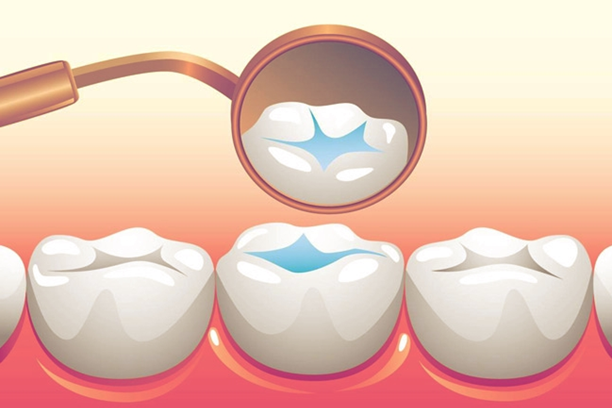 How dental sealants help your teeth from Decay and Pain?