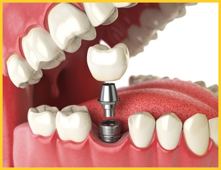 How Dental Implants Can Improve Your Oral Health(Best Dental Implant Specialist In Bangalore)